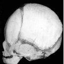 신생아 두개골의 대·소천문에 대한 직관 이미지