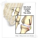 통풍 (요산 관절염 ) 이미지