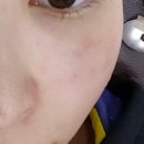 (주)메디에스 | 흐린잡티 레이져 하고왔어요~ (화정 메디에스 피부과)