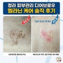 인천 청라 피부관리 디어브로우 셀핏바디피부 남자 잡티제거 후기