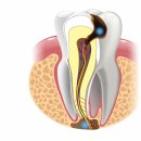 연세올데이치과의원대전 | 대전 유성온천역치과 신경치료는 왜 아플까?