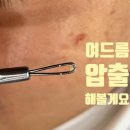 아임스타의원 | 수원 여드름 압출 관리