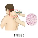 ﻿지방종 (Lipoma) 이미지