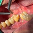 동탄연세원구강악안면외과치과의원 | [아산 연세원치과]어금니 맨 뒤쪽 충치, 양치를 잘해도 막을 수 없었던 '사각지대'의 비밀