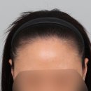 장전로6번길(3-304) | [내돈내산] 내돈내산 여자 헤어라인 모발이식 6개월차 경과 후기