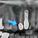 바름치과기공소 | 잠실 치과, 앞니 지르코니아 크라운 재신경치료. (기둥 제거, post)