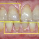 지각과민처치[Hypersensitivity treatment ] 이미지