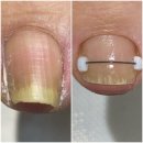 삼보별 | 분당내성발톱 깔끔해져 대만족한 후기