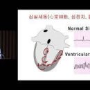 부정맥(Cardiac arrhythmias)증상 이미지