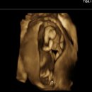 분당-13 | [13주차] 분당차여성병원 1차 기형아검사 후기