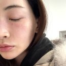 대길케어 | 겨울철 속건조 잡아줄 한남동 피부과 쥬베룩 하이쿡스 관리 후기