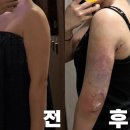 멍샤워 | 다이어트 | 인천 팔뚝지방추출주사 당일후기 (멍,붓기) 무한람스 팔뚝 후기