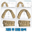 장원치과의원 | 철산역교정치과 과거 잘못된 교정을 역 교정으로 개선해 드린 환자분 증례