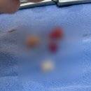 치과 사랑니 전문 치과 레옹치과 매복 사랑니 발치 후기 대학병원 케이스 솔직후기 개그맨 출신...