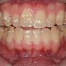 상하치과의원 | 티 안 나는 설측교정 콤비교정으로 돌출입과 비뚤한 앞니 개선한 후기. 심미적 교정장치 종류와 비교