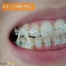 위덴치과병원 | [교정일기] 교정 17개월 _ 교정 고무줄 / 교정용치실 (위덴치아교정치실)
