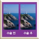 서울신세계안과의원 | 의정부 서울신세계안과 스마일 라식 후기(한 달 후기)