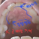 치열이 고르게 난 사람이었는데 6년간 살인진동 고문에 치열이 들쭉날쭉해지고 치아 몇 개는 곧 빠질 기세이고 며칠 전부터 윗니 앞니 이미지