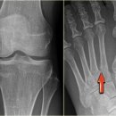 stress fracture 스트레스 골절에 대하여 이미지