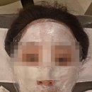 생각자국 | 포텐자RF 후기.리쥬란 톤업부스터 모공·피부결 효과, 엠보자국 솔직후기