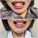 11650-7-12-1 | [5화]센트럴치과 강남점 드디어 1년차(12개월)후기, 성인킬본교정 변화