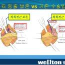 독보적인 고관절인공관절수술 이란? 이미지