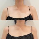 다이아테라피 | [분당/서현역] 메스티 분당서현점 다이아테라피 예비신부 팔뚝관리 후기