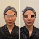 브이(V) | 부산 서면 카리언 뷰티 클리닉 | 서면작은얼굴 서면 '브이로(V-ro) 윤곽관리' 후기