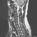 목디스크 치료사례- 6경추 4-5번간 추간판 탈출증으로 인한 팔근력 소실 및 마비환자(김*구님 40세/남자) 이미지