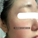 제산한의원 | 주사피부염 완치 불가능한 줄 알았어요