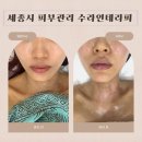 아늑호텔 세종B | 세종시피부관리 수라인테라피 극초단파 리프팅 솔직후기