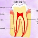 충치(dental caries)﻿ 이미지