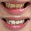 바른니치과기공소 | 당산역 치과 원데이 치아미백 전후 차이 자신 있게 웃을 수 있게 된 후기