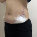 람스네일 - 북구 첨단연신로108번길 128 | 천호 복부 무한람스 당일~1주·2주차 경과 후기, 팔뚝 후 재진행 (멍·붓기·라인변화)