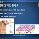 피부암 초기증상 피부 흑색종 편평상피암 기저세포암 증상 원인 점 이미지