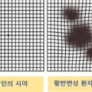 5년사이 2.5배 증가, 소리없이 실명되는 황반변성. 이미지