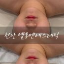 베네핏 에스테틱 | 천안 윤곽관리 하이푸리프팅 엘루엔에스테틱 솔직후기
