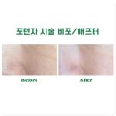 오르타의원 | 신논현역 모공 시술 포텐자 : 오르타의원 후기