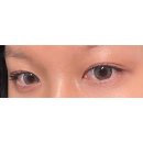 그날성형외과의원 | 그날성형외과 후기, 눈매교정과 매몰쌍수