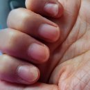 손톱 조갑박리로 몇주전에 글 올렸었는데요 ㅜㅜ 이미지