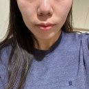 강남역피부과추천 리프팅 튠페이스40kj 솔직후기 전후효과