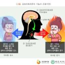 갑상선 기능 항진증 [ hyperthyroidism] 이미지