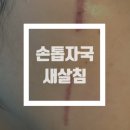 한의원 손톱자국 새살침 후기