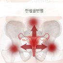 골반염 원인 골반염 예방 골반 통증 이미지