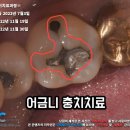 미라치과기공소 | 어금니 충치치료 구강검진 후 3개 치료