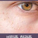 눈밑 비립종 한관종 원인과 제거방법 어떻게 다를까 이미지