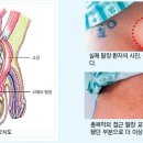 통증없으면서 사타구니 불룩하다면 ‘탈장’ 의심 이미지