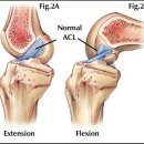 십자인대-격한 운동 후 무릎 통증, 나도 전방 십자인대파열? 이미지