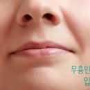 박현성형외과의원 | 인중축소/흉터없는 인중수술-) 제가 윗입술이 얇지가 않아서요 양악하고 나서는 인중이 더 길어질듯...