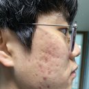 심한 여드름에 생기 아토원 비누 사용후기